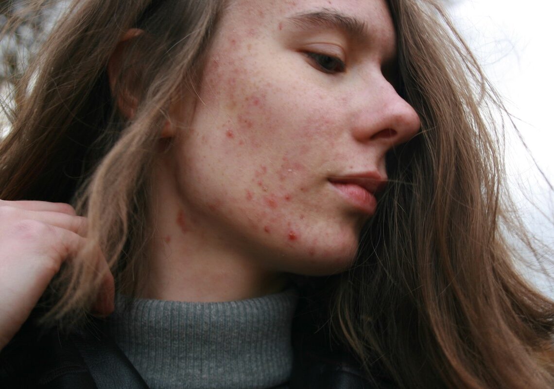 Acne addio! I segreti per eliminarla e prevenirla una volta per tutte