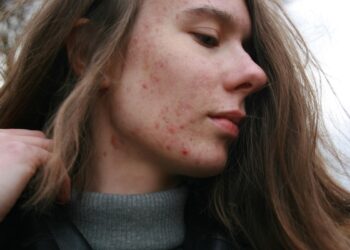 Acne addio! I segreti per eliminarla e prevenirla una volta per tutte